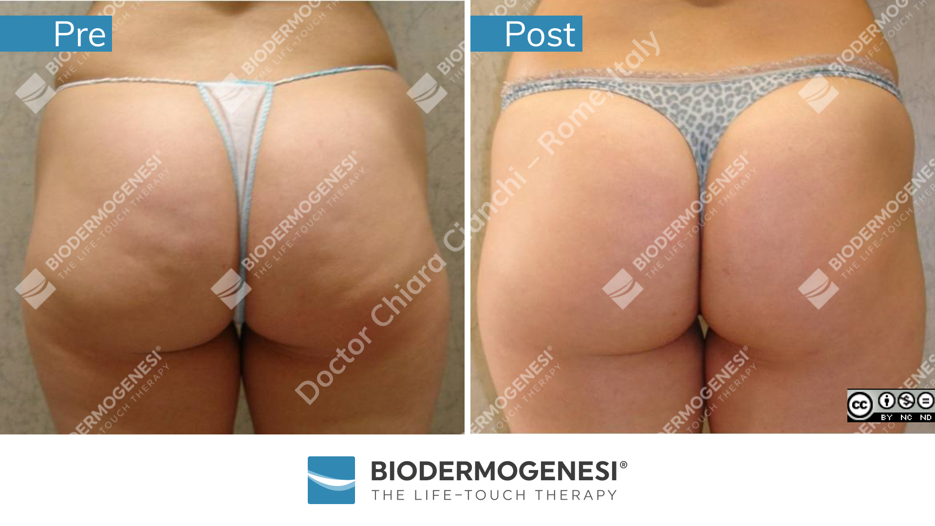 bdg-ce-003-pre e post (2)