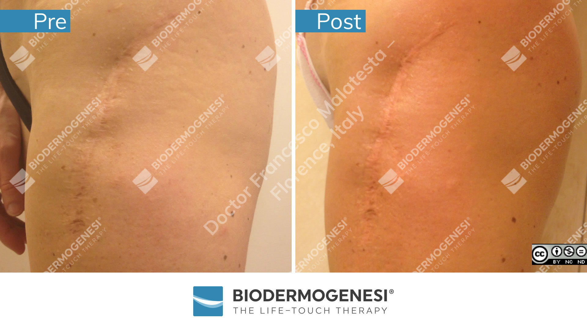 bdg-sc-001-pre e post (2)