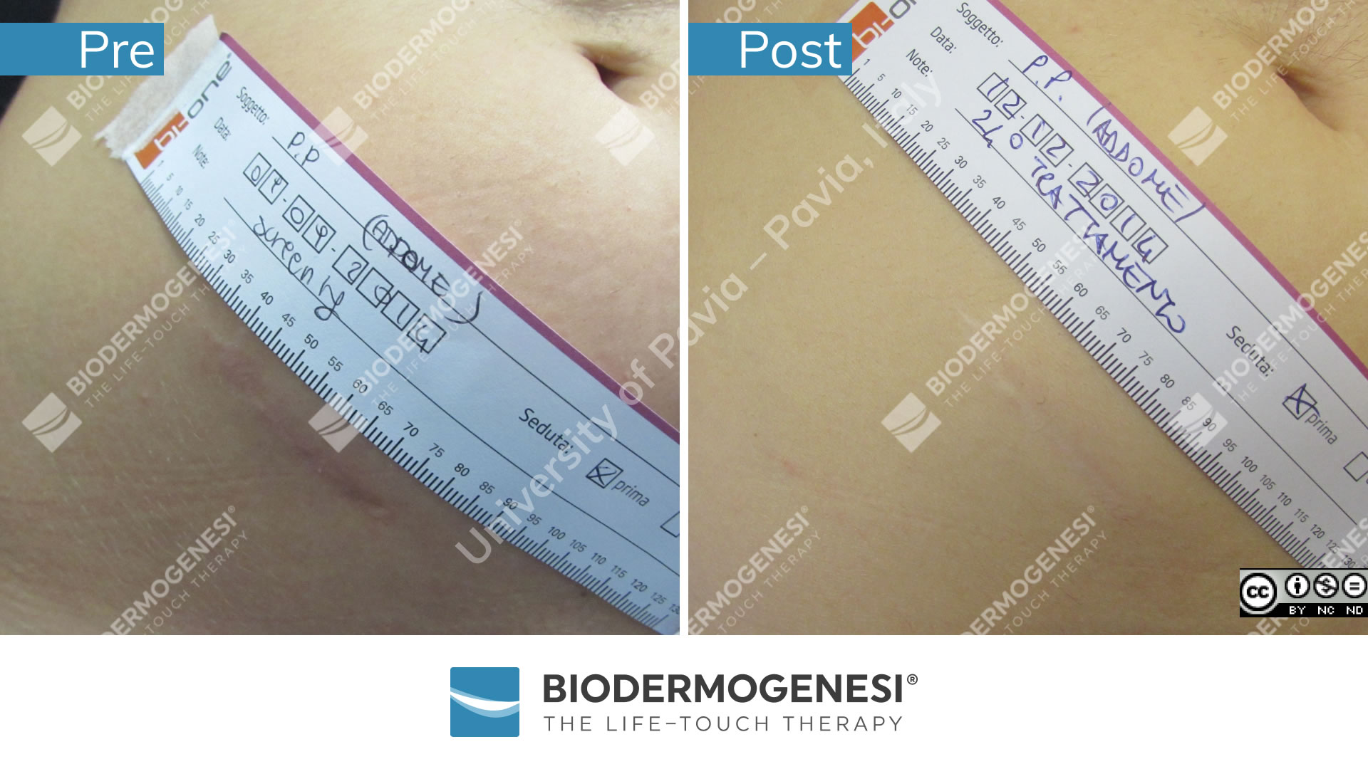 bdg-sc-009-pre e post (2)