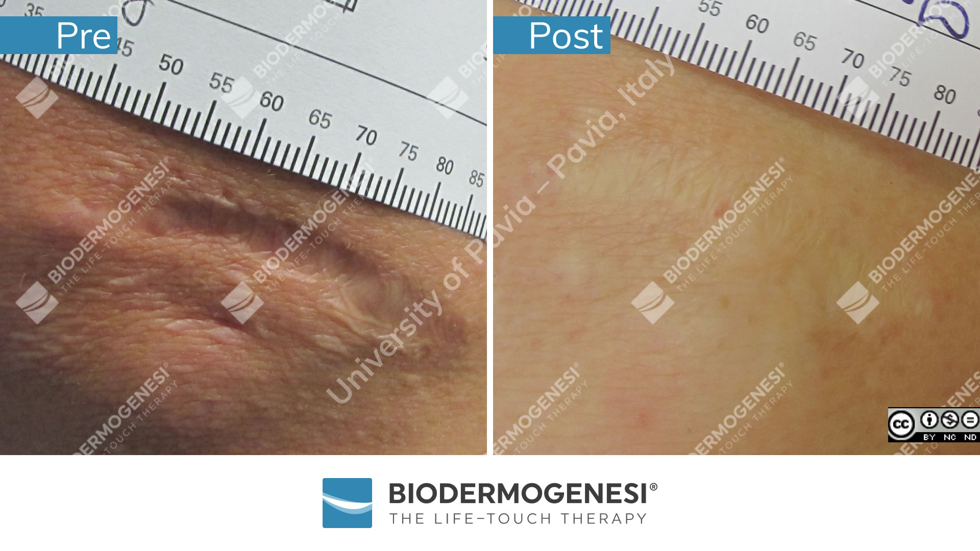 bdg-sc-010-pre e post (2)