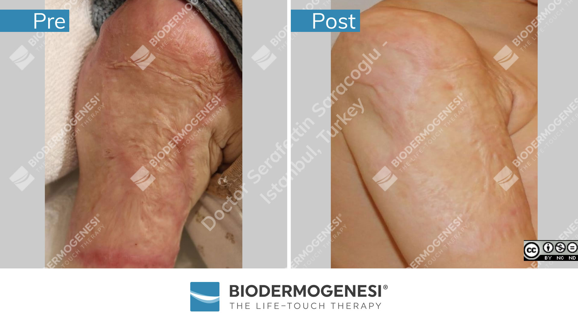 bdg-sc-012-pre e post (2)