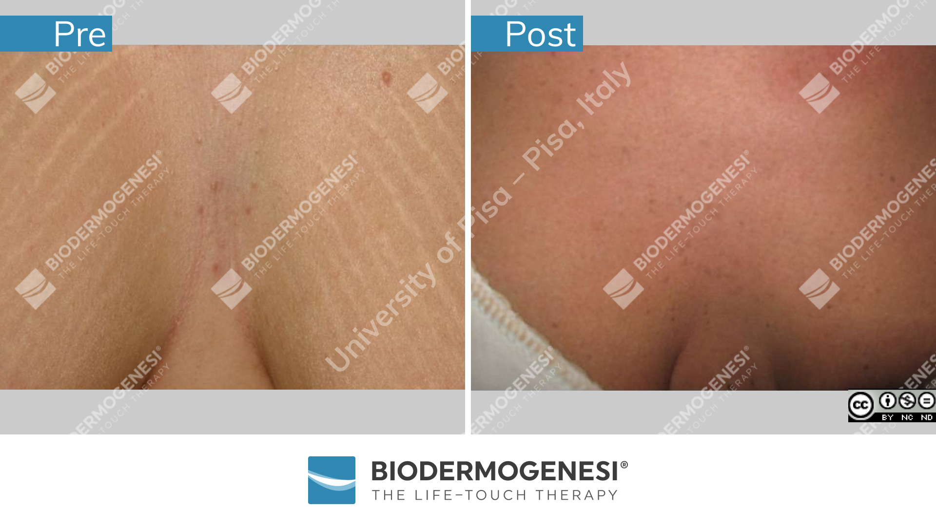 bdg-sm-015-pre e post (2)