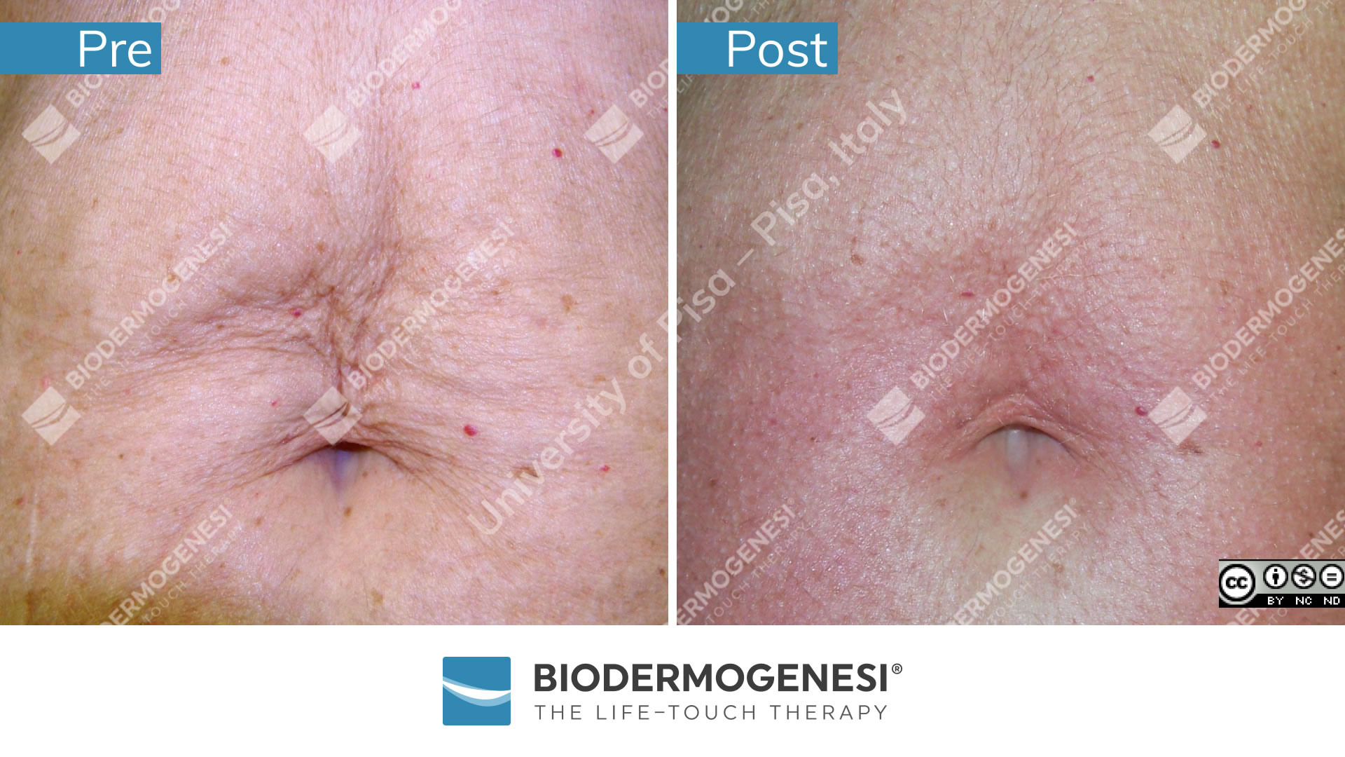 bdg-to-002-pre e post (2)